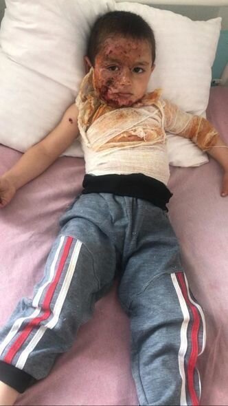 Dörd yaşlı Rəvanın başından aşağı qaynar su tökülüb - FOTO