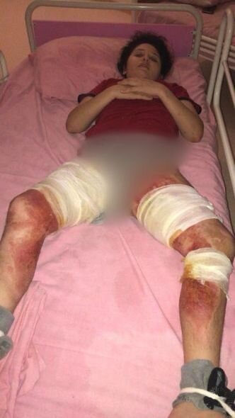 Ağır yanıq xəsarətləri alan qızın yardıma ehtiyacı var: İmkansızlıqdan müalicəsi yarım qalıb - FOTO