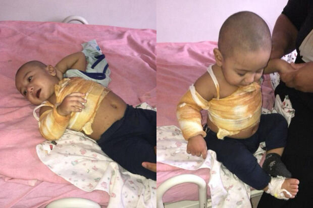 Bədəni yanan Rüqəyyanın anası: "Bir övladımı itirmişəm, ikincini itirməkdən çox qorxuram" - FOTO