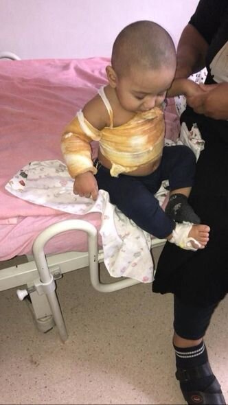 Bədəni yanan Rüqəyyanın anası: "Bir övladımı itirmişəm, ikincini itirməkdən çox qorxuram" - FOTO