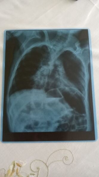 Serebral iflicdən əziyyət çəkən Ömərin anası: "Övladımın müalicəsi üçün 150 manata ehtiyacımız var" - FOTO