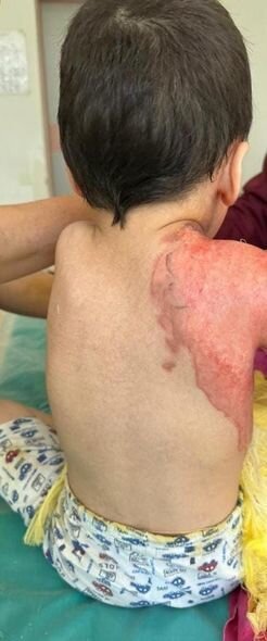 Oyun oynayarkən yanan iki azyaşlı qardaşın köməyinizə ehtiyacları var - FOTO