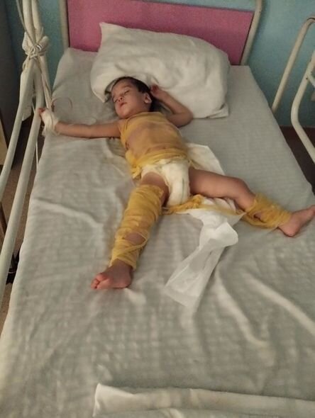 Oyun oynayarkən yanan iki azyaşlı qardaşın köməyinizə ehtiyacları var - FOTO