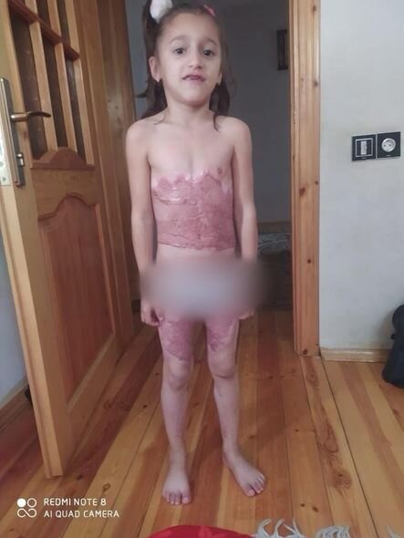 Bütün bədəni yanan yeddi yaşlı Yağmur sizin yardımınıza möhtacdır - FOTO