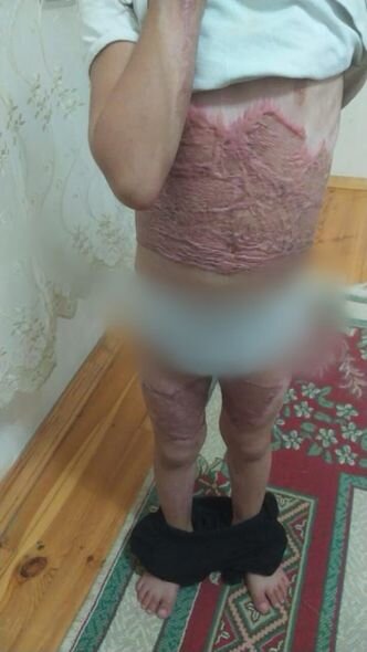 Bütün bədəni yanan yeddi yaşlı Yağmur sizin yardımınıza möhtacdır - FOTO