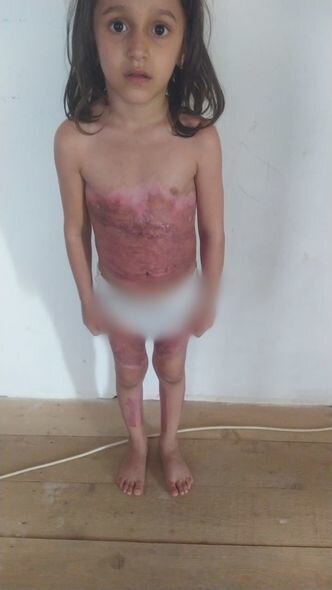 Bütün bədəni yanan yeddi yaşlı Yağmur sizin yardımınıza möhtacdır - FOTO