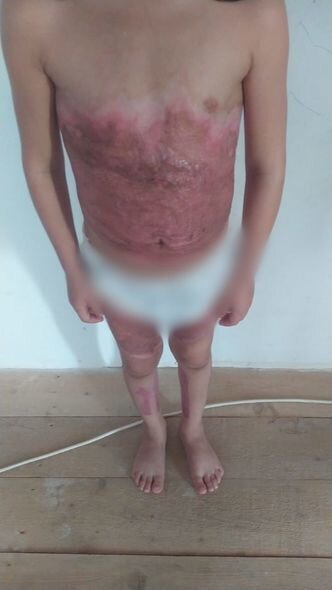 Bədəni yanan Yağmur yardıma möhtacdır: Sizdən kömək gözləyir - FOTO