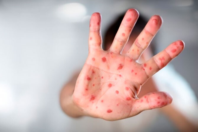 Zaqatalada 64 nəfər qızılcaya yoluxub