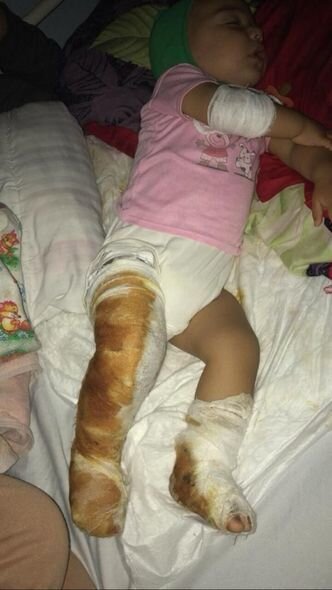 Bədəni yanan körpənin atası fəryad edir: "Dərmanlarını almaq üçün 500 manata ehtiyacımız var" - FOTO