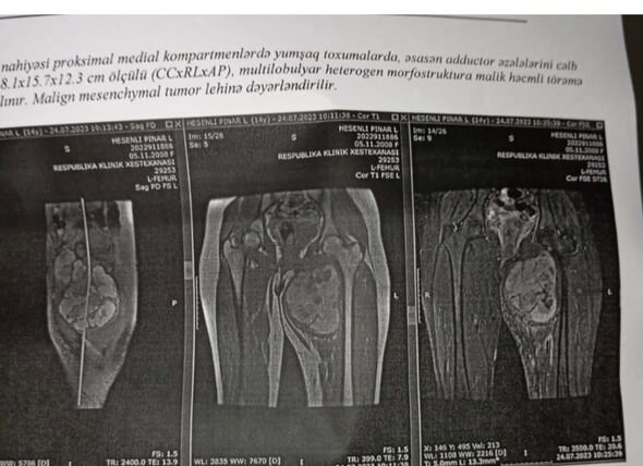 Yeganə qızı xərçəng xəstəsi olan anadan yardım ÇAĞIRIŞI: 15 min manat toplamalıyam - FOTO