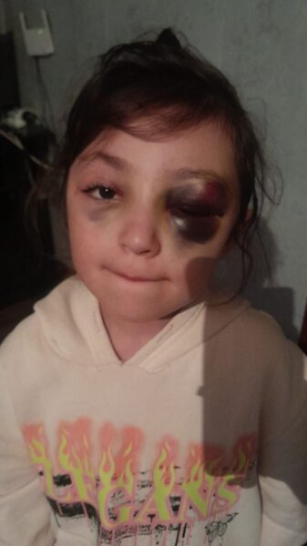 Ramanadaki orta məktəbdə 2-ci sinif şagirdi döyüldü - FOTO