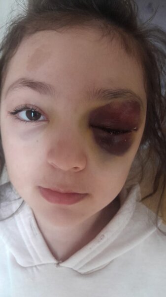 Ramanadaki orta məktəbdə 2-ci sinif şagirdi döyüldü - FOTO