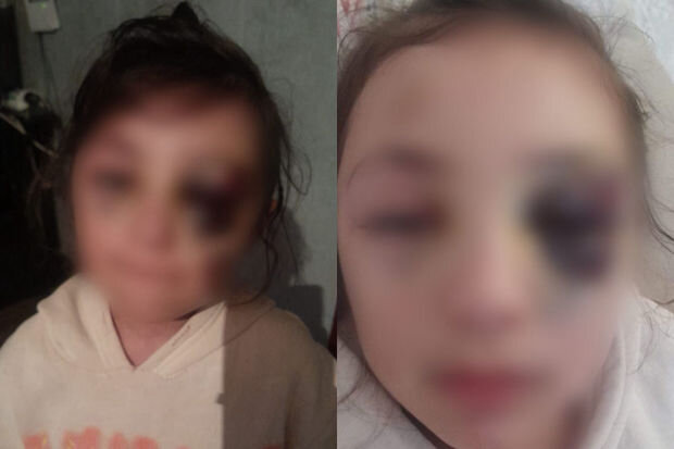 Ramanadaki orta məktəbdə 2-ci sinif şagirdi döyüldü - FOTO