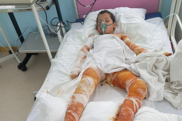 Bədəni yanan Sərxanın anası fəryad edir: "Müalicə üçün dəstəyə ehtiyacımız var" - FOTO