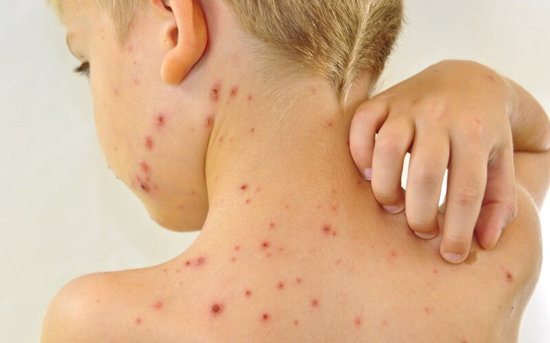 Qızılcadan qorunmağın yolları AÇIQLANDI - RƏSMİ AÇIQLAMA