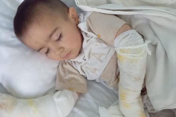 İki yaşlı Asimin əlləri yanıb: Müalicə üçün 500 manat lazımdır - FOTO