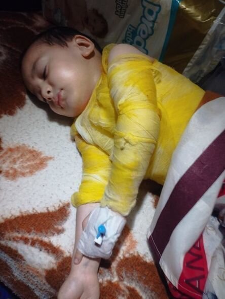 Bədəni yanan azyaşlının atası: "Uşaqlar bayramda Şaxta babanın onlara hədiyyə gətirməsini gözləyirlər" - FOTO