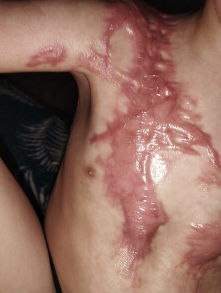 Bədəni yanan azyaşlının atası: "Uşaqlar bayramda Şaxta babanın onlara hədiyyə gətirməsini gözləyirlər" - FOTO