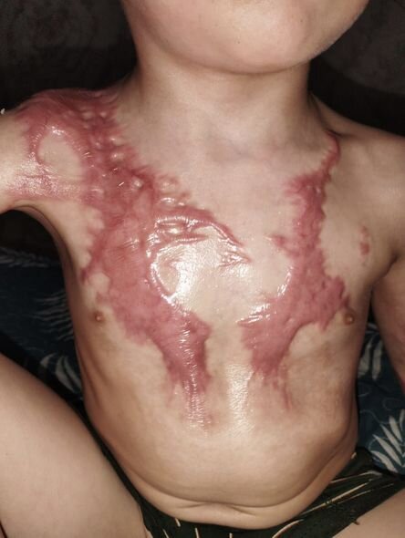 Bədəni yanan azyaşlının atası: "Uşaqlar bayramda Şaxta babanın onlara hədiyyə gətirməsini gözləyirlər" - FOTO