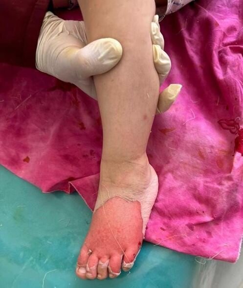 Bədəni yanan azyaşlının atası: "Uşaqlar bayramda Şaxta babanın onlara hədiyyə gətirməsini gözləyirlər" - FOTO