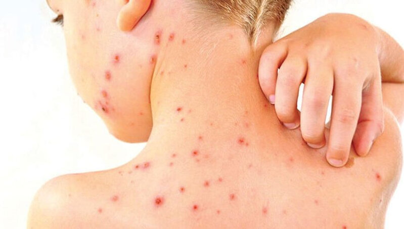 SN: Qızılca idarə olunan infeksiyalar qrupuna daxildir