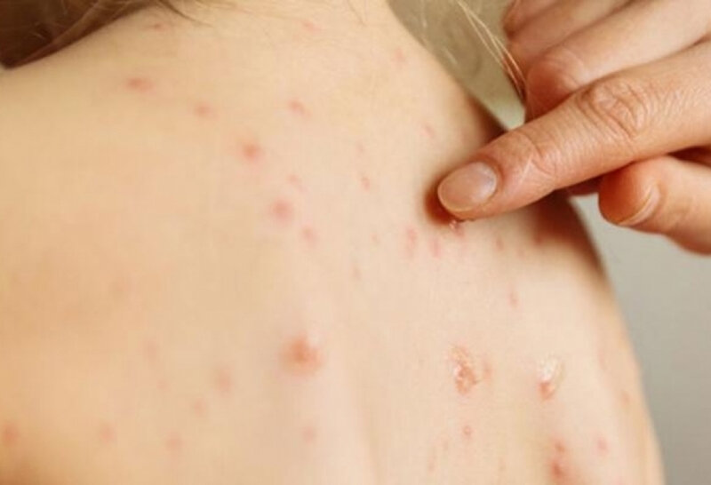 Səhiyyə Nazirliyi: "Qızılcaya yoluxma halları artıb"