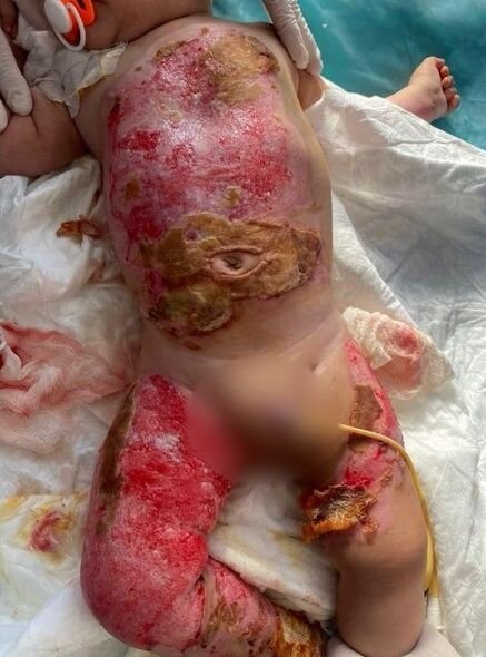 Bütün bədəni yanan körpənin anası fəryad edir: "Ağrılarına görə bütün günü ağlayır" - FOTO