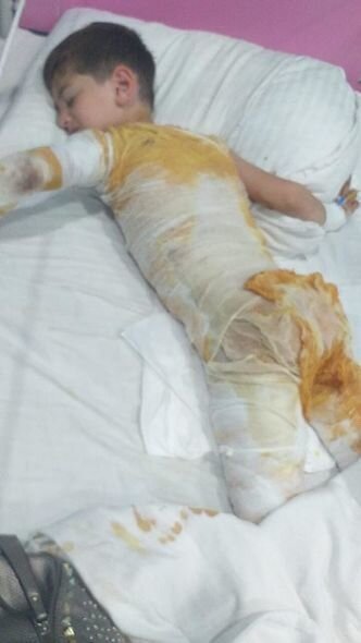 Bütün bədəni yanan Yusifin anası: "Yemək almağa belə pulumuz yoxdur, ağlamaqdan halsız düşür" - FOTO