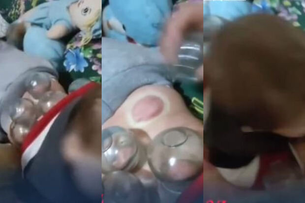 7 aylıq uşağın belinə banka qoydular - Sağlamlığına hansı fəsadlar yarana bilər? - FOTO/VİDEO