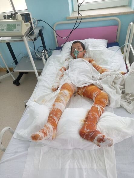Bütün bədəni yanan Sərxanın anası yardım diləyir: "Müalicələrini davam etdirə bilmirik" - FOTO
