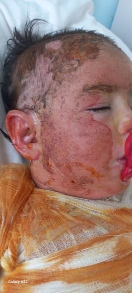 Qaynar suda yanan üç yaşlı Xədicənin sizin köməyinizə ehtiyacı var - FOTO