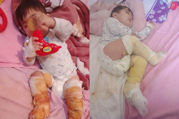 Körpə Muradın dəstəyə ehtiyacı var: Üzərinə qazan aşırdaraq yanıb - FOTO