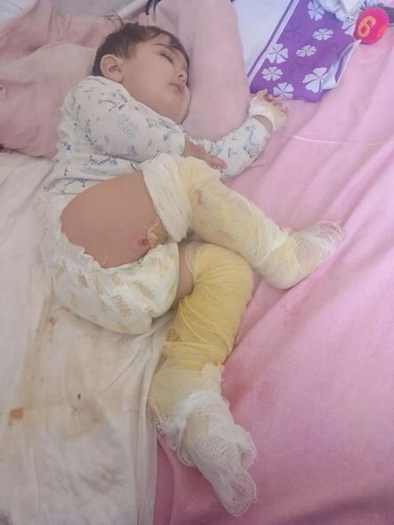 Körpə Muradın dəstəyə ehtiyacı var: Üzərinə qazan aşırdaraq yanıb - FOTO