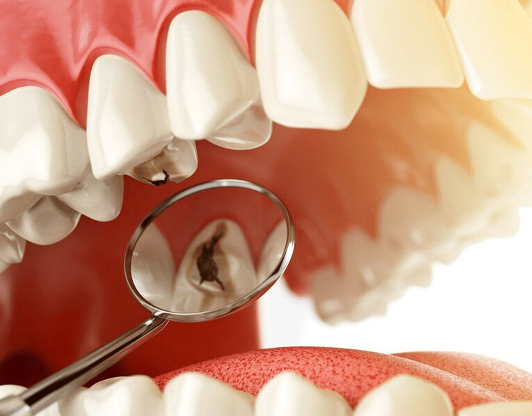 Rus alimləri kariesə qalib gəldiklərini açıqlayıblar