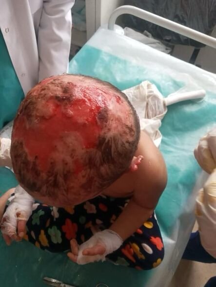 Yanğında xəsarət alan iki yaşlı Zeynəbin sizin köməyinizə ehtiyacı var - FOTO