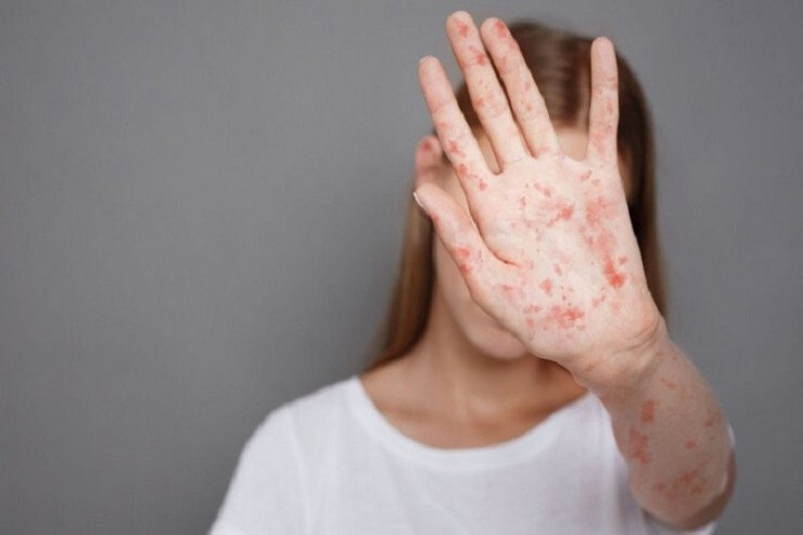 Azərbaycanda daha bir məktəbli qızılcadan öldü