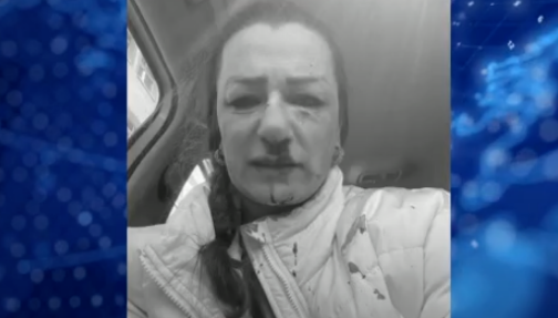 Azərbaycanlı qadın sosial şəbəkədə tanış olduğu türk kişi tərəfindən vəhşicəsinə DÖYÜLDÜ - FOTO