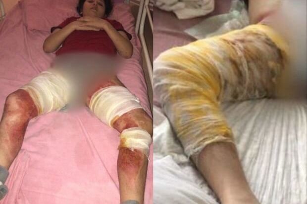 Ağır yanıq xəsarətləri alan qızın yardıma ehtiyacı var: İmkansızlıqdan müalicəsi yarım qalıb - FOTO