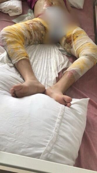 Ağır yanıq xəsarətləri alan qızın yardıma ehtiyacı var: İmkansızlıqdan müalicəsi yarım qalıb - FOTO