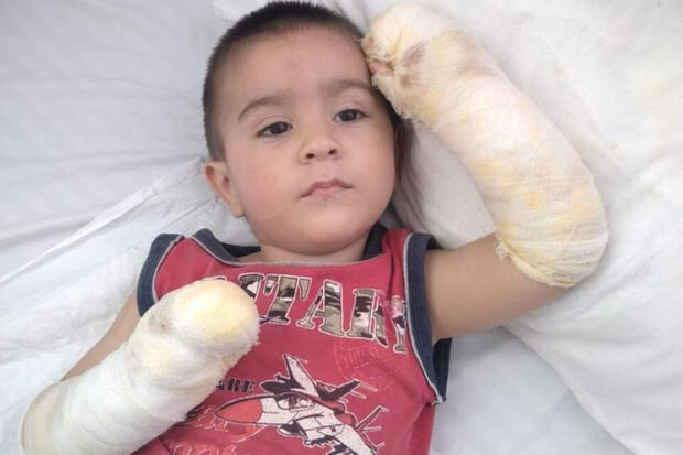 İki yaşlı Asimin əlləri yanıb: Müalicə üçün dəstəyə ehtiyacları var - FOTO