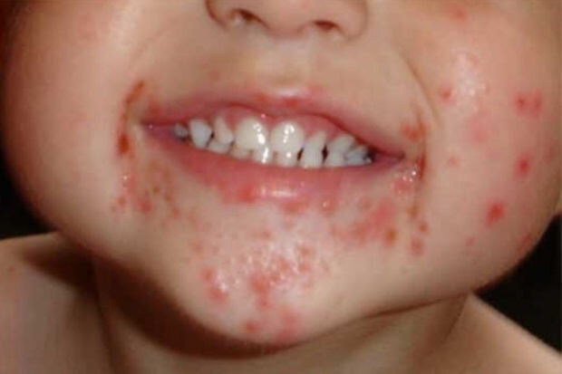 Azərbaycanda azyaşlılar arasında daha bir virus yayılıb - VİDEO