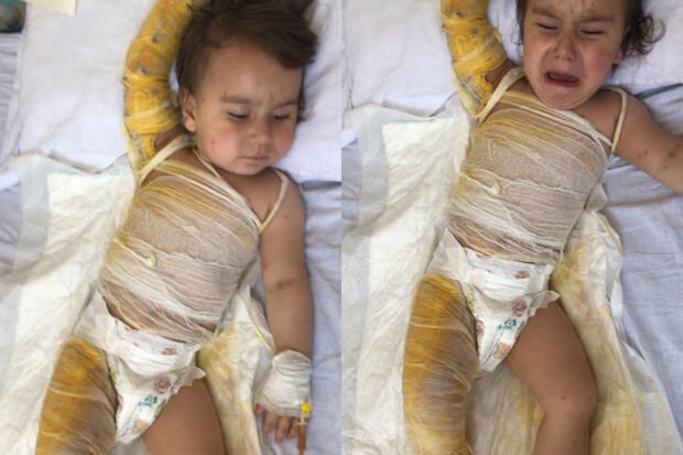 Balaca Zəhranın dəstəyə ehtiyacı var: Müalicəsi yarımçıq qalıb, dərisi çürüyür - FOTO