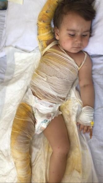 Balaca Zəhranın dəstəyə ehtiyacı var: Müalicəsi yarımçıq qalıb, dərisi çürüyür - FOTO