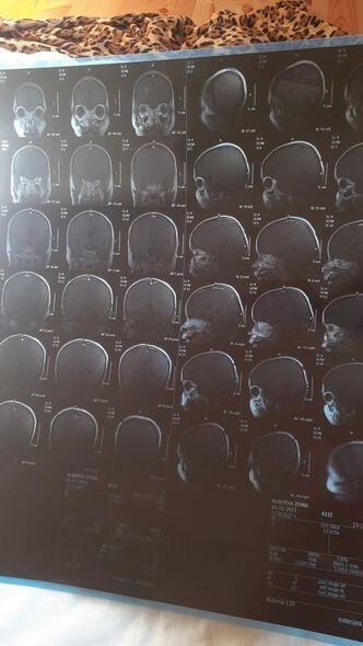 İki ağır xəstəliyi olan Zəhranın anası: "Epilepsiyası tutanda qorxuram geri qaytara bilməyim" - FOTO/VİDEO