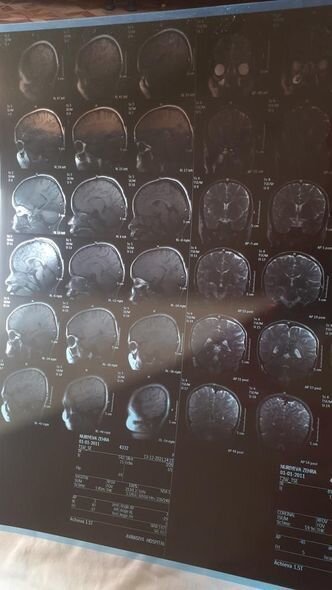 İki ağır xəstəliyi olan Zəhranın anası: "Epilepsiyası tutanda qorxuram geri qaytara bilməyim" - FOTO/VİDEO