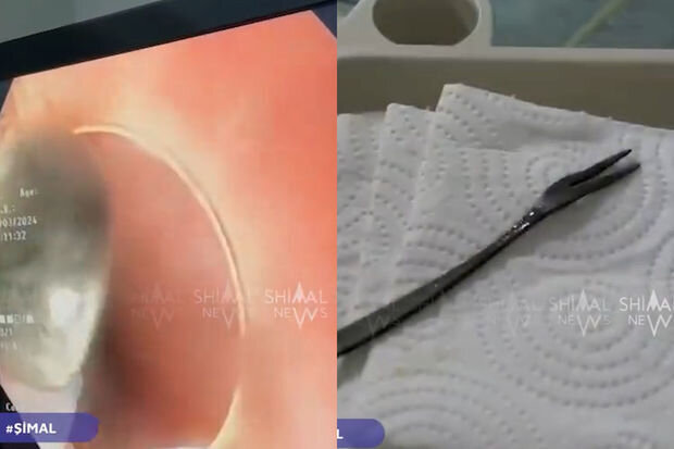 Xaçmaz sakini bir aydan çox mədəsində çəngəllə yaşadı - VİDEO