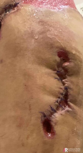 Plastik-cərrah Ülviyyə Ağazadənin növbəti QURBANI: Bədən şəkilləndirmə edən xanımı az qala öldürürdü - FOTO