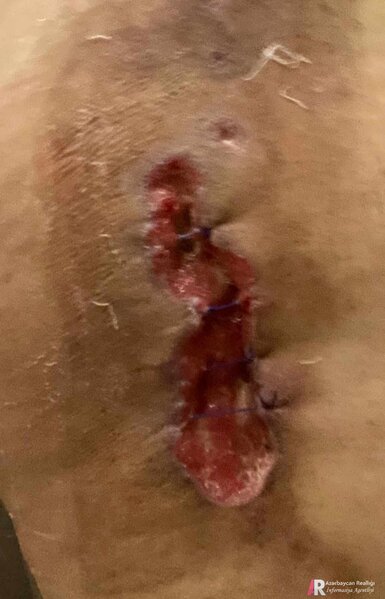 Plastik-cərrah Ülviyyə Ağazadənin növbəti QURBANI: Bədən şəkilləndirmə edən xanımı az qala öldürürdü - FOTO