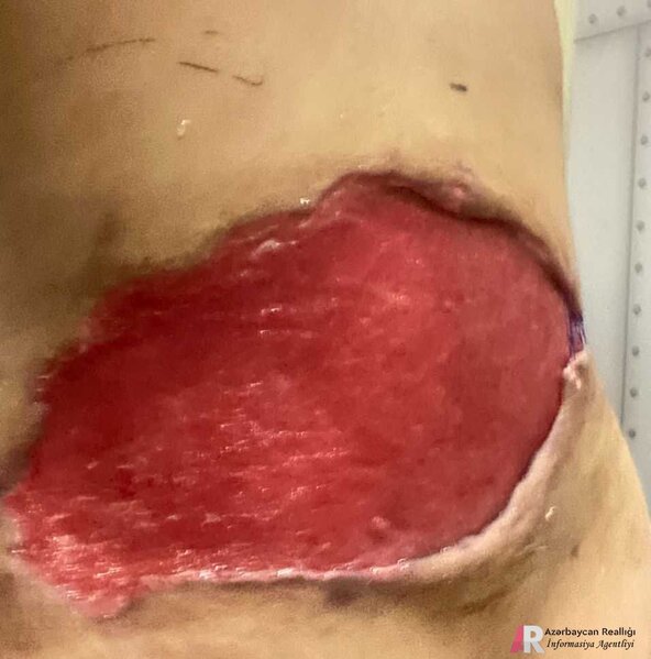 Plastik-cərrah Ülviyyə Ağazadənin növbəti QURBANI: Bədən şəkilləndirmə edən xanımı az qala öldürürdü - FOTO