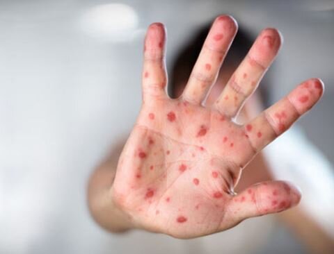 Qızılca daha bir gəncin ölümünə səbəb oldu – Azərbaycan dünyada birincidir